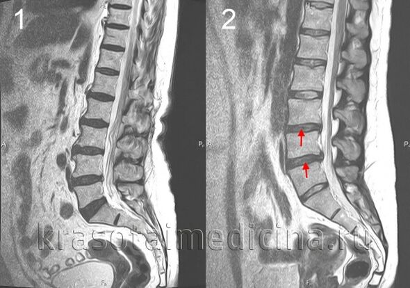 Osteohondroza kralježnice